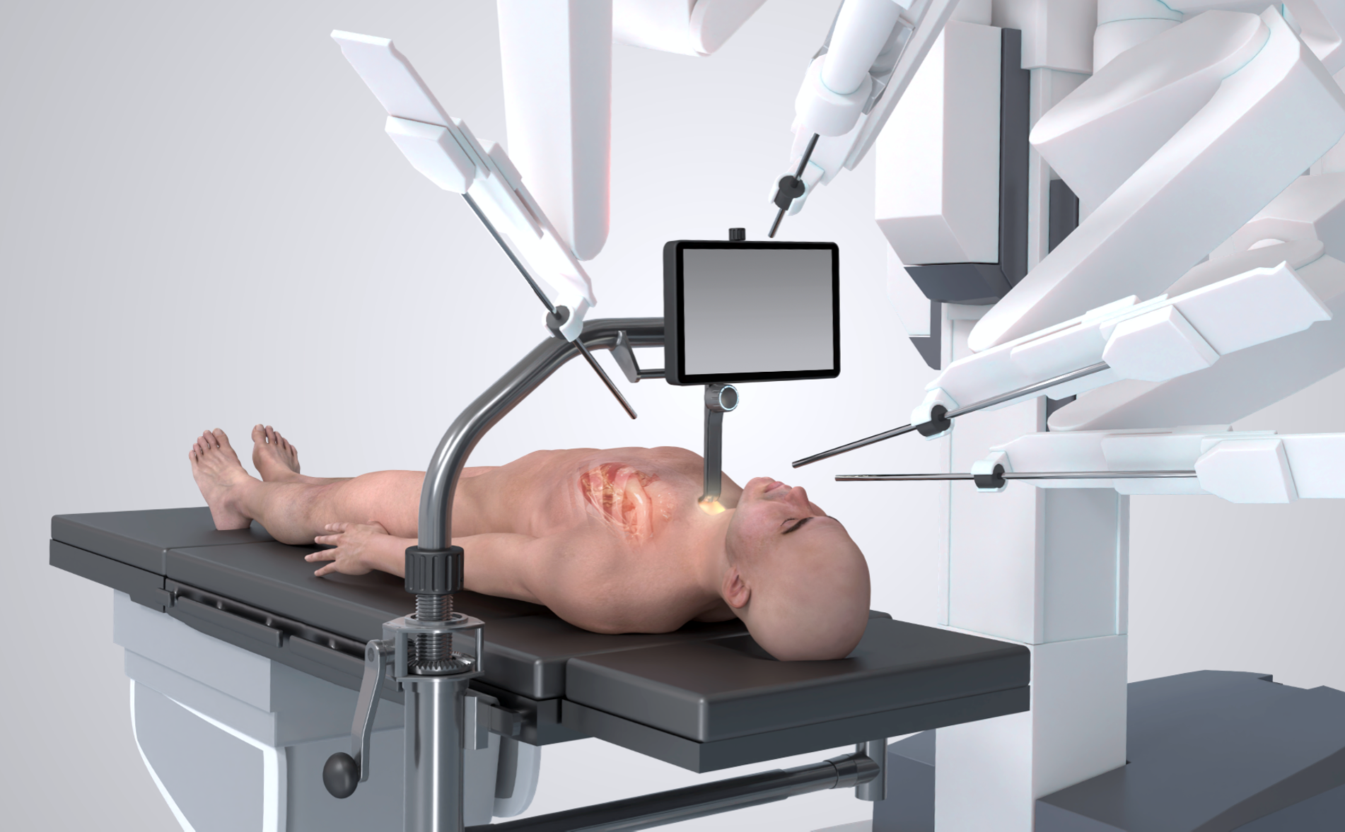 A graphic representation of the equipment used in Cardioprecision's robotic surgery.